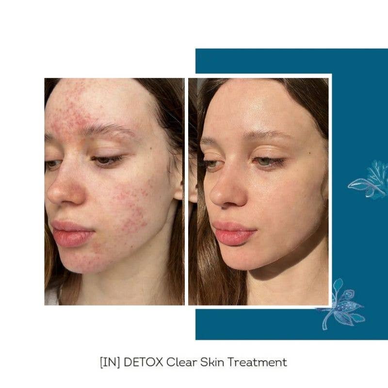 FLORÊVE [IN] DETOX Clear Skin Cure